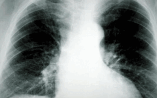 2014-10-16-epistimi-karkinos-tou-pneumona