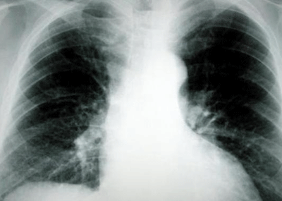 2014-10-16-epistimi-karkinos-tou-pneumona